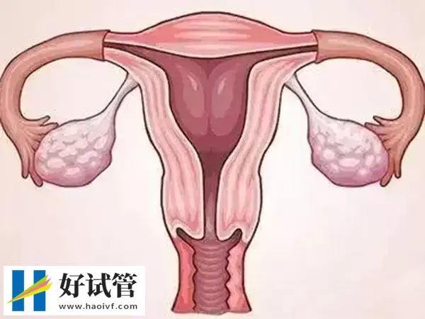 多囊卵巢做试管婴儿是否要降调(图1) 多囊卵巢做试管婴儿是否要降调(图1)