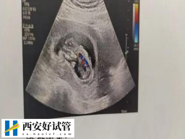 三个卵泡都破了怀孕的几率多大(图2) 三个卵泡都破了怀孕的几率多大(图2)