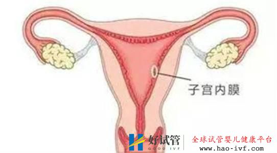 做俄罗斯试管婴儿需要调理内膜吗?调内膜一般要多少天(图1) 做俄罗斯试管婴儿需要调理内膜吗?调内膜一般要多少天(图1)