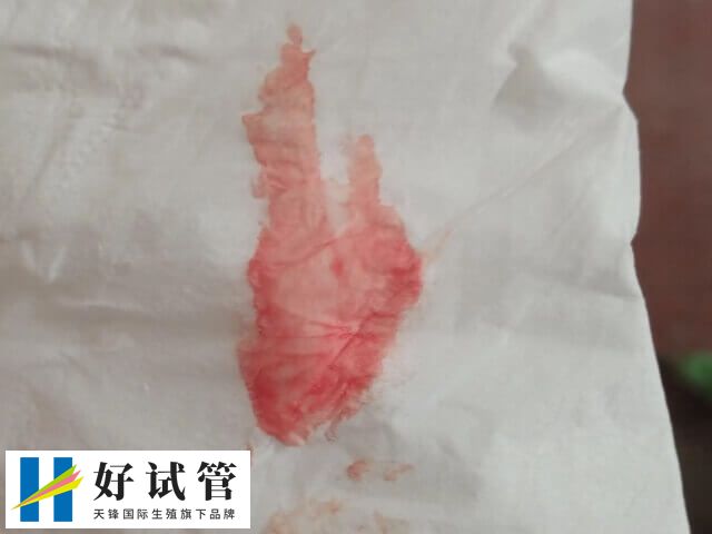 试管移植后出血是什么情况(图1) 试管移植出血可能是着床出血