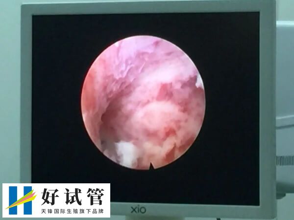 宫腔镜手术后吃坤复康多久(图2) 宫腔镜检查是一种重要的妇科检查方法
